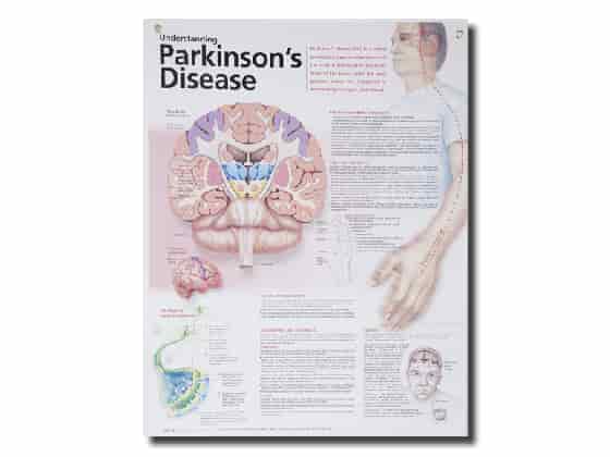 Anatomisk Affisch, Parkinssons Syndrom.